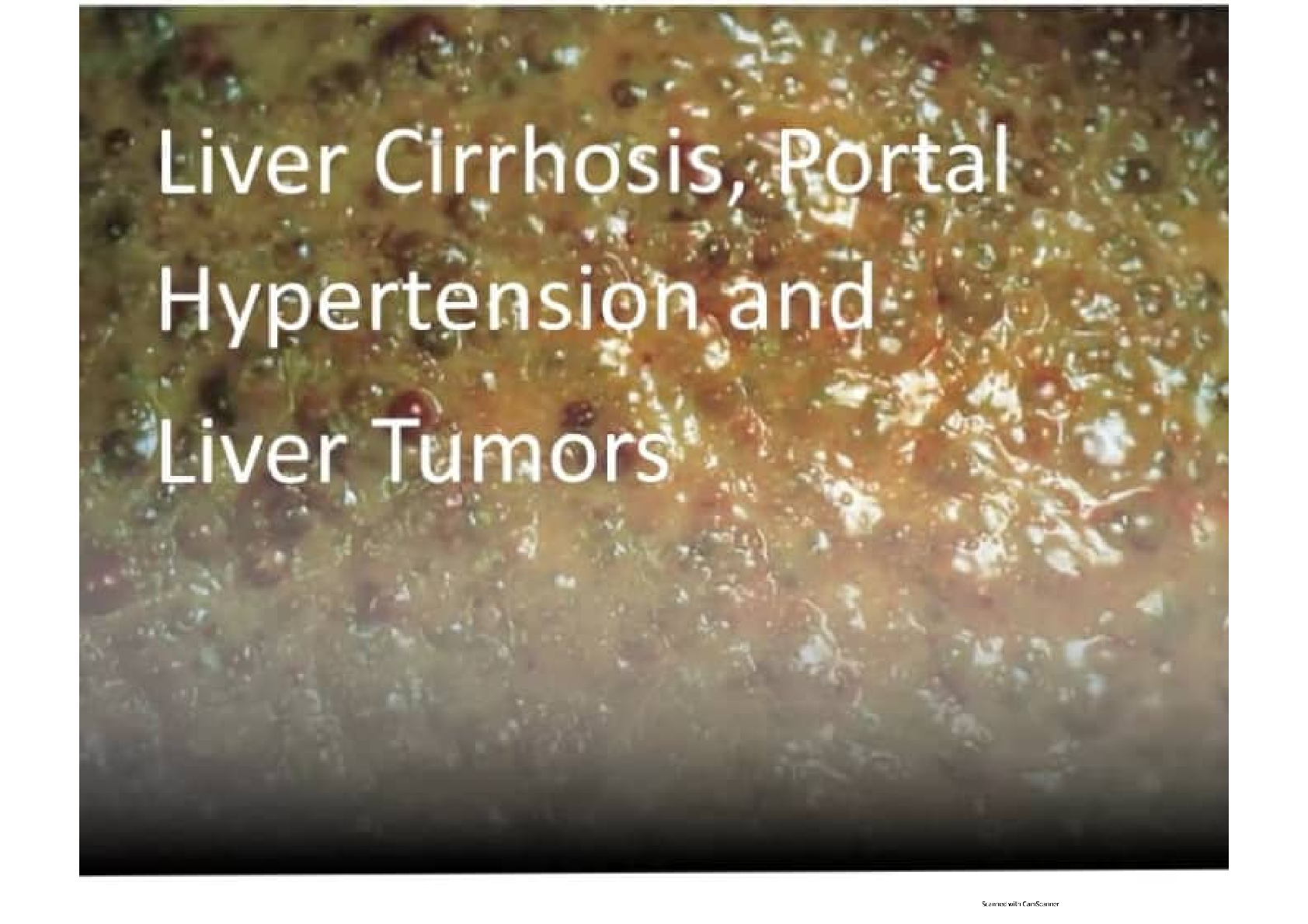 Preview image for LIVER CIRRHOSIS, PORTAL HYPERTENSION AND LIVER TUMORS
